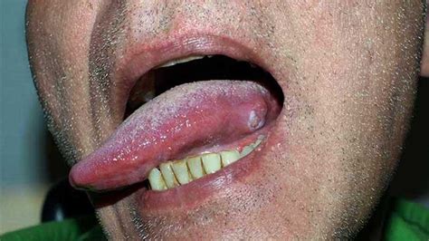 Mouth Cancer Bumps Under Tongue