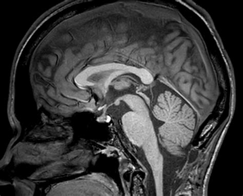 Anatomy Of Brain In Mri