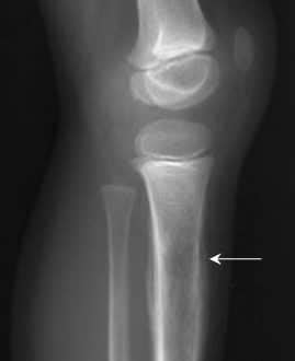 Ewing Sarcoma X Ray