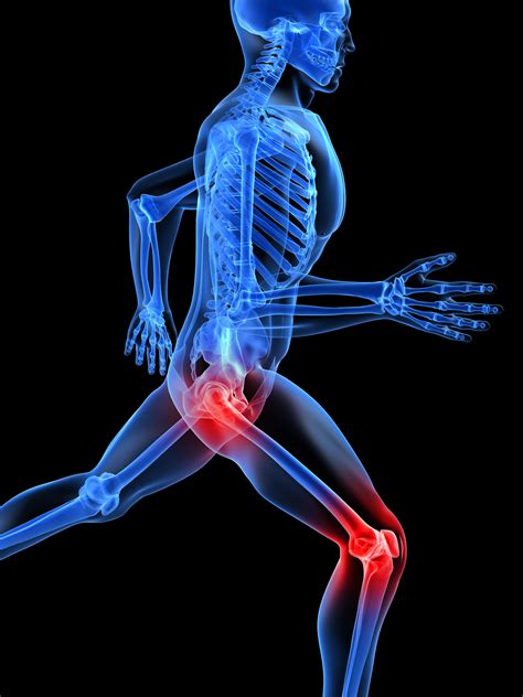 Rheumatoid arthritis mechanisms may vary by joint | National Institutes ...