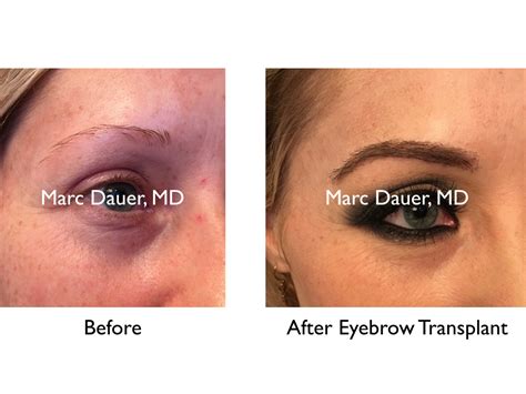 Eyebrow Transplant Photos Gallelry | Marc Dauer MD