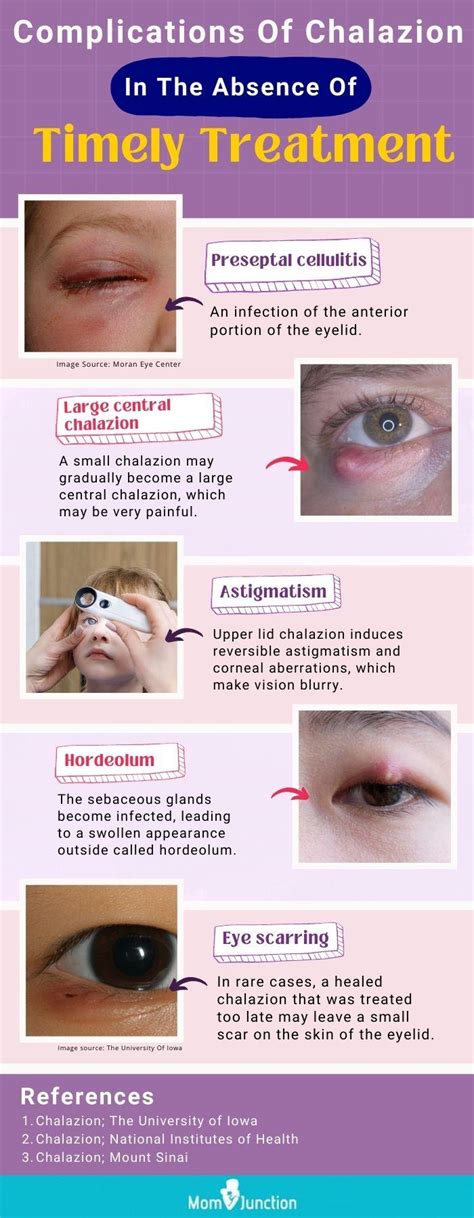 Chalazion Self-care Compare Cheap | 2022.markettraders.com