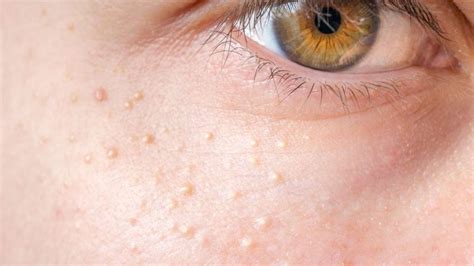 What Are These White Spots on My Face? | Advanced Dermatology