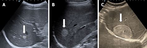 Cavernous Hemangioma Liver Ultrasound