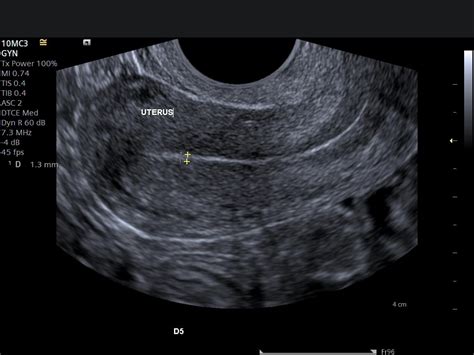 Normal Uterus Measurements Ultrasound