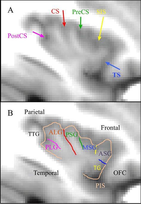 Main structures drawn on left insula of the average MRI of 30 subjects ...