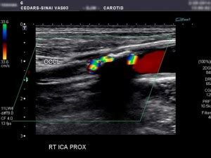 Carotid Duplex Ultrasound - LICC