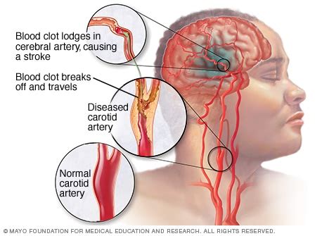 Carotid artery disease - Symptoms and causes - Mayo Clinic