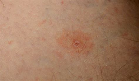 Tick Bite – Pictures, Symptoms, Causes, Treatment | HubPages