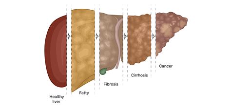 Early Symptoms of Liver Disease: How to Recognize, Test & Treat ...