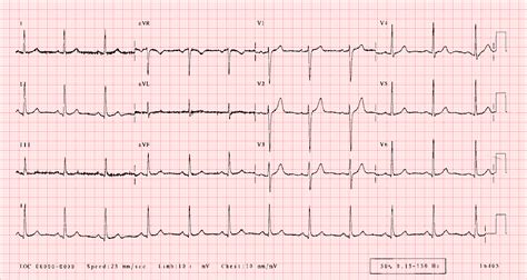 Normal Ecg Tracing