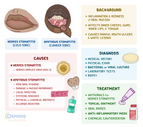 Aphthous Stomatitis Treatment