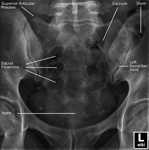 Sacrum Radiographic Anatomy | Diagnostic imaging, Radiology imaging ...