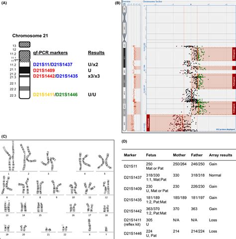 A, Rapid aneuploidy detection (RAD) testing of chromosome 21 showed ...