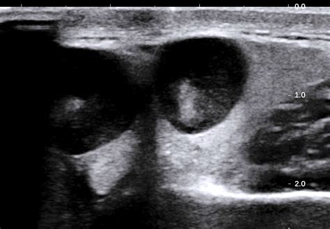 VIETNAMESE MEDIC ULTRASOUND: CASE 469: T CELL LYMPHOMA OF SUBMANDIBULAR ...