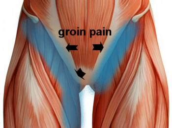 Groin Pain, Groin Strain Treatment. Upper Thigh Pain, Hip Pain, Hernia ...