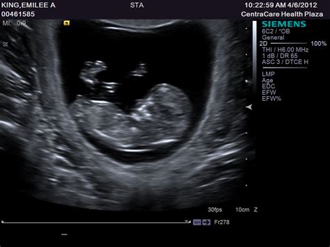 Lillie Mae: 10 Week Ultrasound Picture: