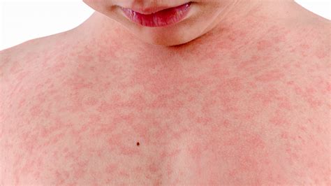 Rash on Chest Pictures, Causes, Symptoms, Remedies and Treatment ...