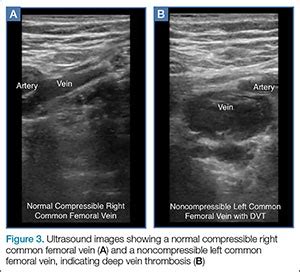 Blood Clot In Leg Ultrasound