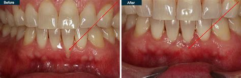 Gum Grafting Procedure