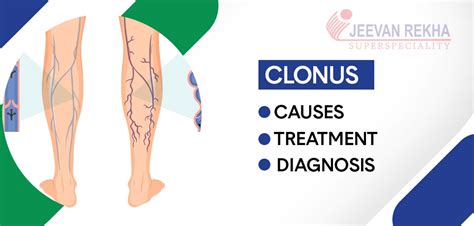 Clonus: Causes, Diagnosis, and Treatment