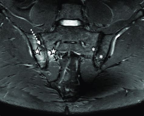 The MRI aspect of the sacroiliac joints included pseudo-widening of ...