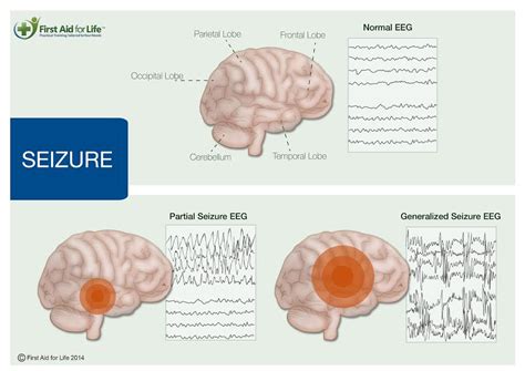 Seizures, convulsions and epilepsy and how to manage them