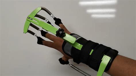 Dynamic splint for radial nerve injury - YouTube