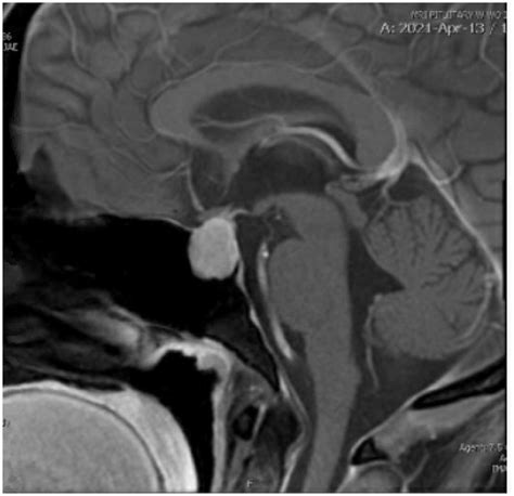 Frontiers | First Episode Psychosis and Pituitary Hyperplasia in a ...