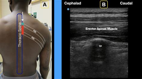 erector spinae plane block Fig5 - ACEP Now