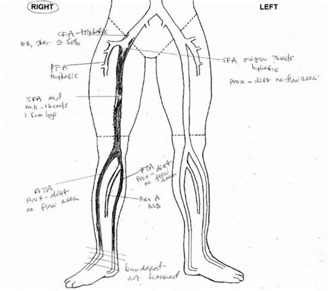 Femoral Artery Stent