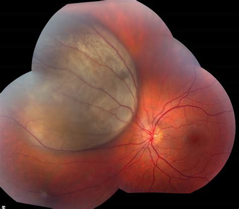 Melanoma, choroidal. Causes, symptoms, treatment Melanoma, choroidal