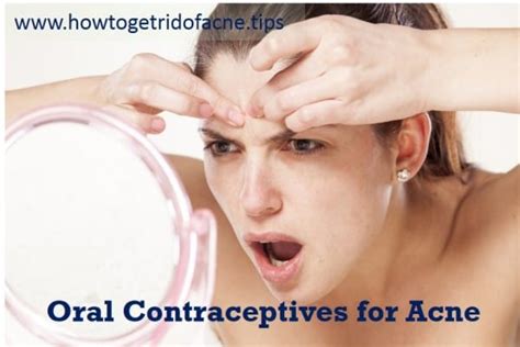 Can Oral Contraceptives Help in Treating Acne Vulgaris?