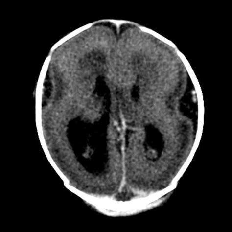 Lissencephaly - A figure of 8 appearance to the cortex. The cortex is ...