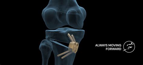 Knee Osteotomy, Kinds of Osteotomy, Dr Vinay Tantuway