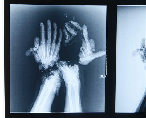 Gonzagas broken hand X-Ray | Page 2 | Sherdog Forums | UFC, MMA ...