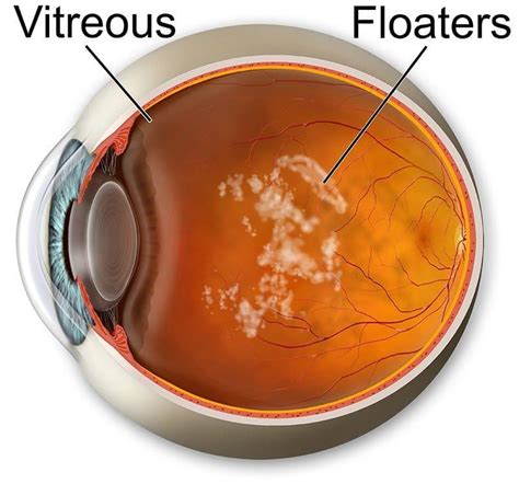 Summary of Retinal Diseases - South Pasadena, CA: Retina Eye Specialists