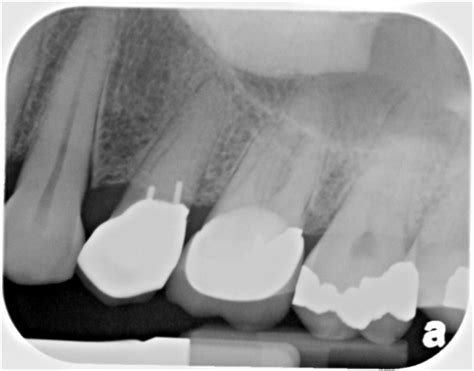 Case of the Week: Palatal Tori – Dr. G's Toothpix