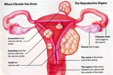 Uterine Fibroids - Non Surgical Fibroid Treatment