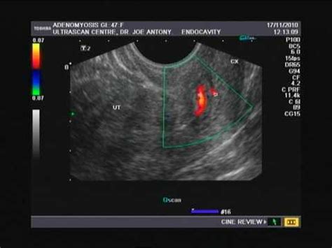 cervical polyp of uterus- ultrasound and color Doppler imaging - YouTube