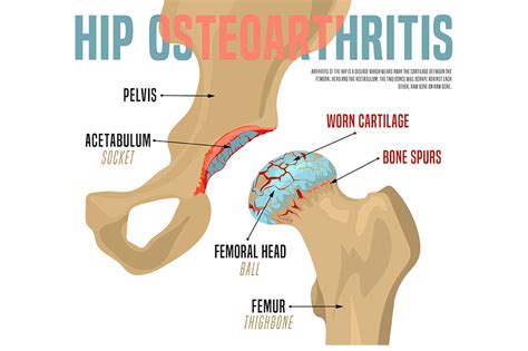 Hip Osteoarthritis Treatment Without Steroids or Surgery