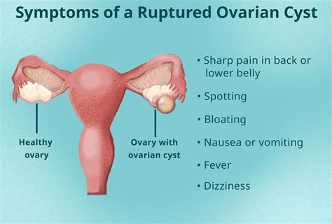 Ovarian Cyst Pain What Does It Really Feel Like?