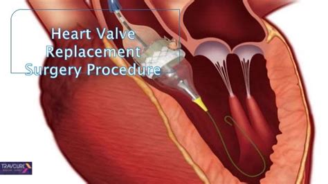 Heart valve replacement surgery procedure