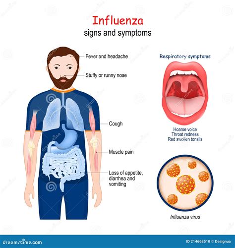 Influenza. the flu stock vector. Illustration of runny - 214668510