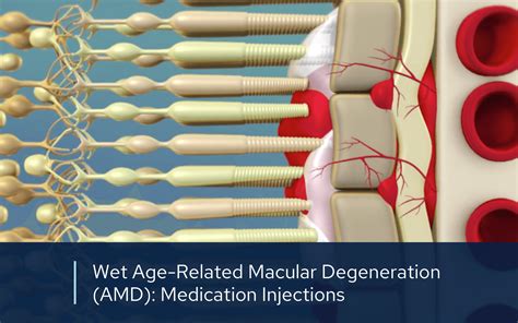 Avastin, Eylea & Lucentis Injections | Retinal Consultants Medical Group