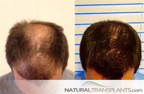 Regrow Hair Products | Hair Transplant Before and After # ...