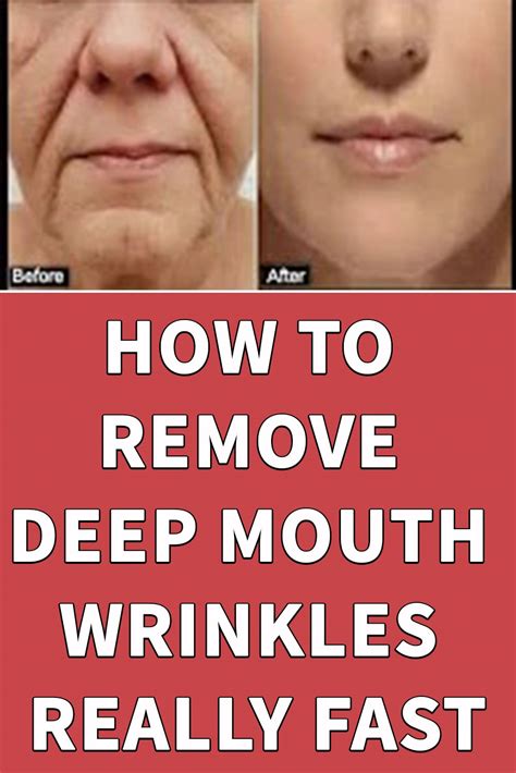 HOW TO REMOVE DEEP MOUTH WRINKLES REALLY FAST in 2020 | Mouth wrinkles ...