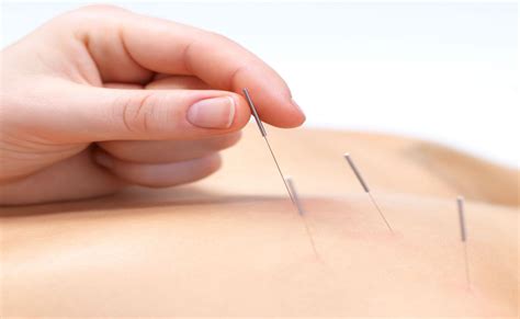 What is Acupuncture? - Pro Holistic - acupuncture explained