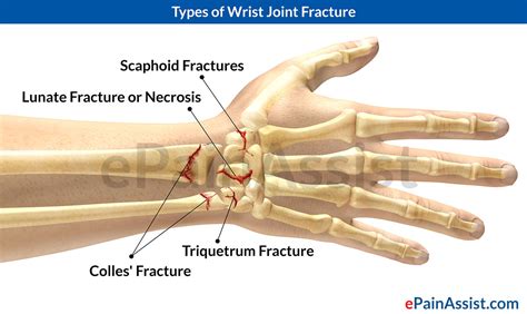 Hand Injuries: Wrist fracture | Health Life Media