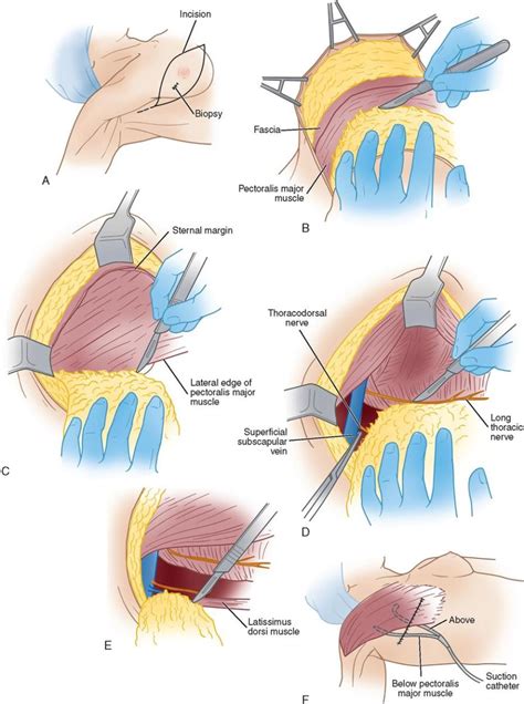 8. Breast Surgery | Basicmedical Key